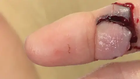 Jillian Tisdale Jillian's hand injury - severe lacerations, degloving of middle finger and dislocation of index finger