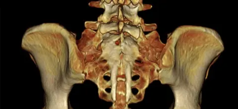 Getty Images Spina bifida