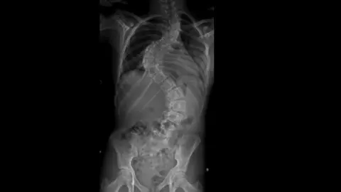 Megan Fleming Megan's spine x-ray