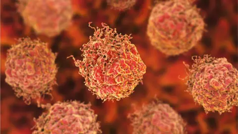 Getty Images Illustration of 3D prostate cancer cells