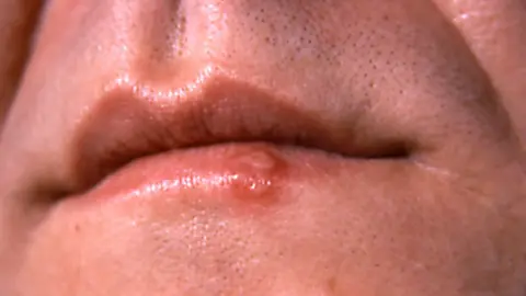 Getty Images Cold Sore on mouth