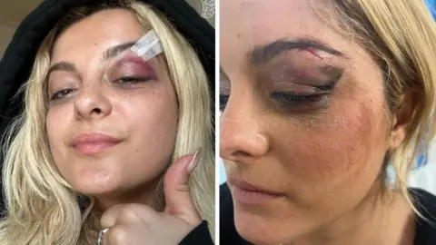 Bebe Rexha / Instagram Bebe Rexha with a black eye and bandage on her eyebrow