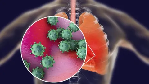 Getty Images Graphic showing virus and lungs