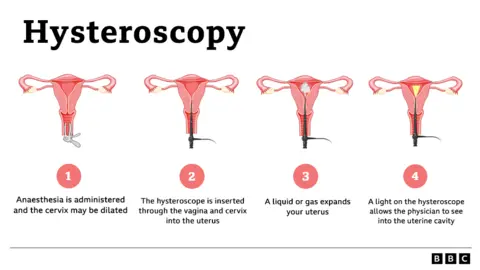 Infographic: What is a hysteroscopy?