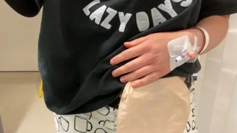 Kayleigh Adams Kayleigh Adams with a stoma bag fitted