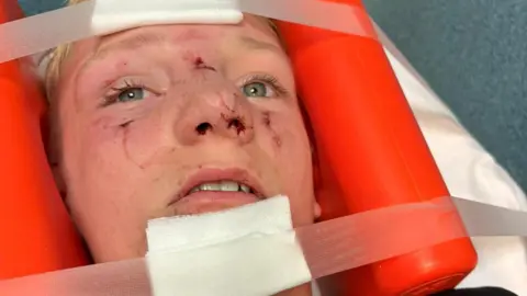A 12-year-old boy, with blonde hair, lies on a hospital stretcher with his head held in place by an orange brace. There are bandages on his forehead and chin held in place by medical tape, he has dried blood and cuts on his face, and his nose is visibly swollen. 