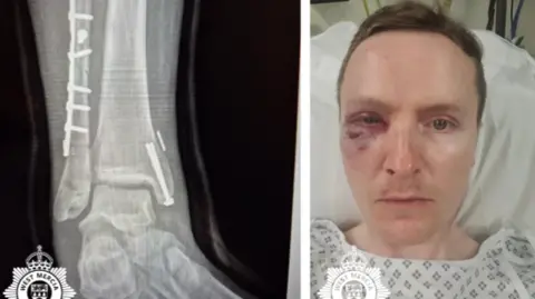 West Mercia Police A black and white x-ray of a bone and a man with short brown hair with bruises around his eye. He is wearing a white patterned top. 