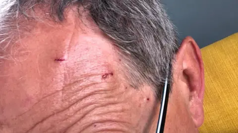 Simon Harris Close-up of a grey-haired man with cuts on his forehead