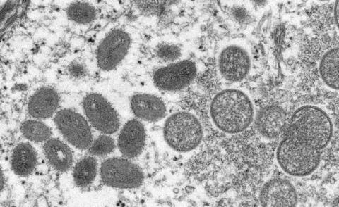 Electron microscope image of various virions (virus particles) of the monkeypox virus taken from human skin