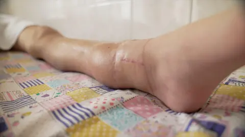 Lera's leg shows scar