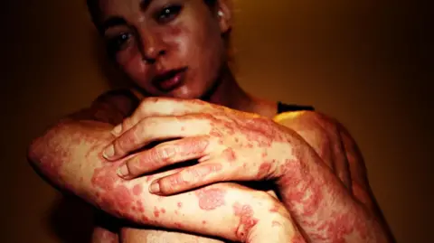 Giorgia Lanuzza A woman looks into the camera. Her arms are folded in front of her and her skin has psoriasis scales on it.