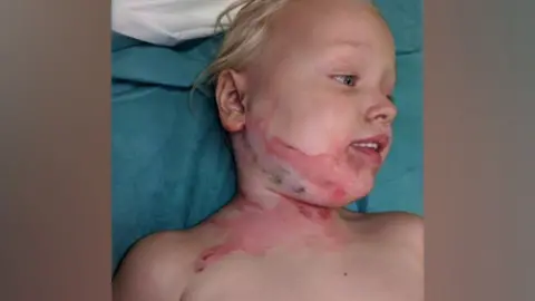 Family photo 4-year-old Rosie-May with red burns on her neck and head. 