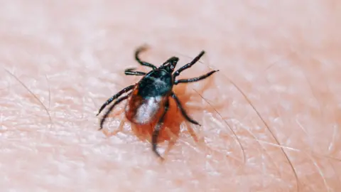 Close-up of a tick attached to human skin, showing the insect’s body and legs in detail.
