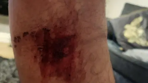 Danny Cooke A grazed and bruised leg