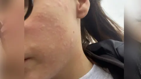 PA Media Amber's face up close with hives all over her cheek she is wearing a round neck grey top and dark rimmed glasses