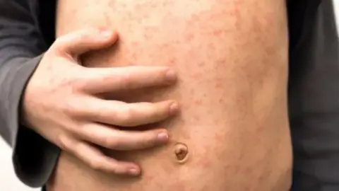Getty Images A close up of a stomach of a child that has the red measles rash. He is holding his stomach with one hand. 