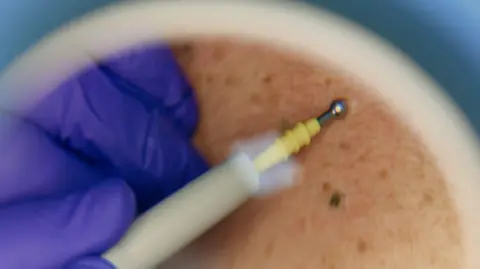 A person with a blue glove on looking at a person's skin through a magnifying glass