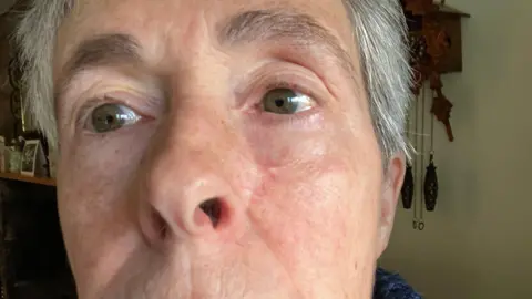 Lis Dales A close-up view of Lis Dales' face before the operation to remove her basal cell carcinoma. A small blemish is visible on her left cheek.