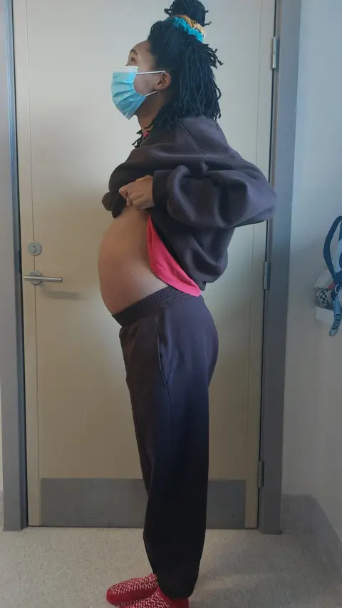 Shalisha James-Davis Shalisha is in a clinical area, wearing a mask. She is facing to the left, in profile, and has pulled her jumper up to reveal the large swollen area across her abdomen.