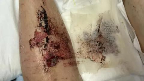 Callum Laird A bloodied, injured leg, lying on a hospital bed. The rest of the patient is not in view. 