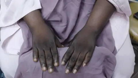 A woman wearing a lilac dress holds up her bleached hands to show the contrast between her darker knuckles and areas of paler skin. 