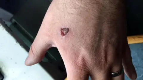 Paul Tool's hand which shows a scab in the area between his thumb and index finger