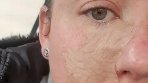 Levi-Mariah Verrall Close up of the right side of Levi-Mariah Verrall's face showing skars under the eye after skin cancer surgery