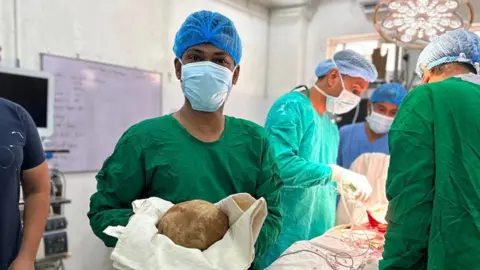 A surgeon in a green gown and face mask poses with a large gallstone in his hands