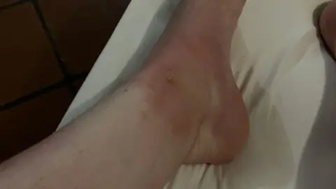 supplied Close up a woman's ankles that look bruised and sore.