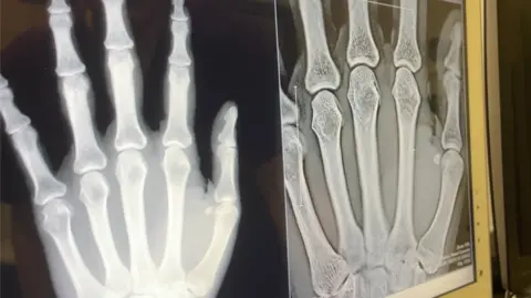 Two scan images next to each other on a screen, showing the bones of someone's left hand
