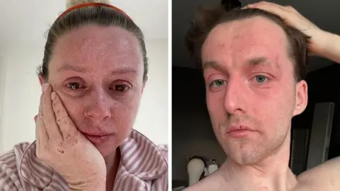 Two pictures of people with TSW. The left pic is of Rebecca and she has red, sore, peeling skin on her face. She is crying. The pic on the right is of Henry, he has a red face and he looks in pain