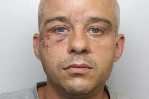 West Yorkshire Police Matthew Rycroft, pictured with shaved grey hair and bruising to his right eye and the right side of his face.