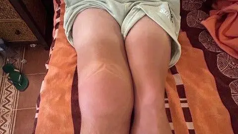 Hudgell Solicitors Photo of man's legs one knee swollen twice the size of the other