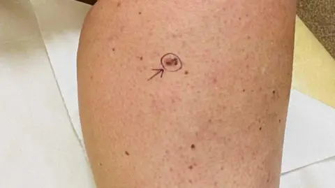 Sharon McLucas A close up view of Sharon McLucas's leg showing various freckles. A larger freckle or mole is circled in black ink with an arrow pointing to it.