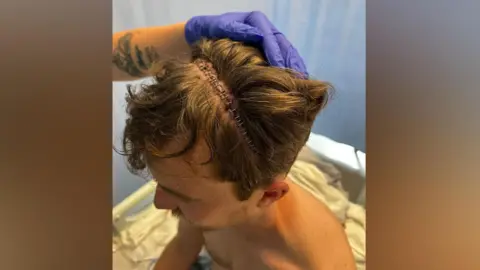 Family handout The image shows a man, seen from above. He has a very large fresh scar across his scalp. The wound is held together with staples. His hair is being held back by a nurse to show the camera the scale of the scar. He is sitting on a hospital bed. 