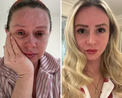 Rebecca Ebbage Two pictures of Rebecca, in the left pic she is in TSW, her skin on her face is red and flaking, and she is crying. In the right pic she is in recovering, her skin looks clear and she is wearing make up she looks happy and healthy