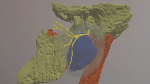 The Susannah Morgan hologram shows a large blue area which is a tumor with the yellow facial nerve passing through it. The neck is red and the rest of the head is green.