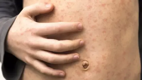 Getty Images A close-up of a child's tummy with a hand placed on the stomach, both covered in a red rash