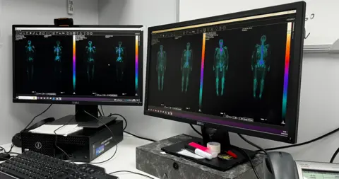 Two computer screens show images taken with radio-isotope scans. Both have two skeletons on them, each of which has orange and purple patches on the bones where the cancer has spread