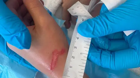 NHS Greater Glasgow and Clyde A close-up of a boy's burned hand, being held by medical professionals who have measuring tape next to it to show how badly it was affected. 