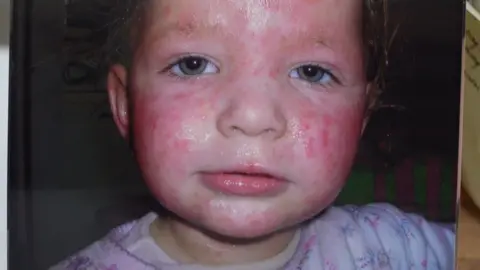 Shaun Whitmore/BBC Poppy when she was a young child with severe eczema across the face.