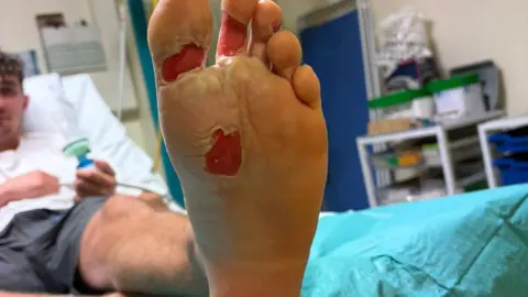 Sam Knight A man's foot showing the skin peeling away from his big toe and clear signs of burns in other parts. He is lying down in a hospital bed.