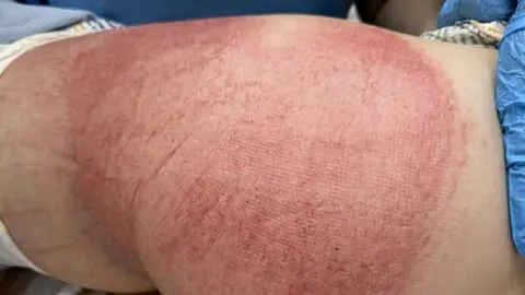 Callum Laird Burns on the leg and rear of Callum Laird, as he lies in a hospital bed