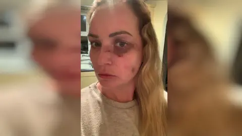 Suzanne Symonds A woman with a black eye and cuts on her face. She is wearing a grey jumper.