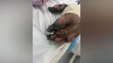 Marshall Wylie A hand, barely recognisable as such, rests on a hospital bed sheet. The hand is black and wrapped partially in gauze, and his fingers are deformed with swelling.