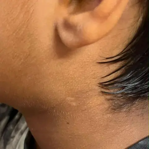 Supplied A boy's neck which shows a scar which formed after a boy was hit by an ebike while playing in a public park.