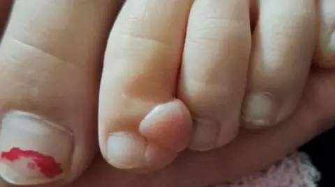 Leila Evans Nansi Alys' foot. On her second toe is a lump which was initially diagnosed as a wart, but it turned out to be a form of cancer