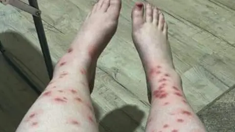 Other A woman's legs showing several insect bites