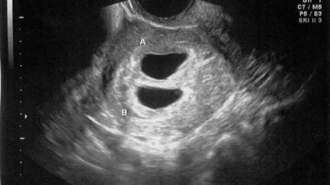 Getty Images A generic image of an ultrasound scan of a twin pregnancy at about four weeks gestation.