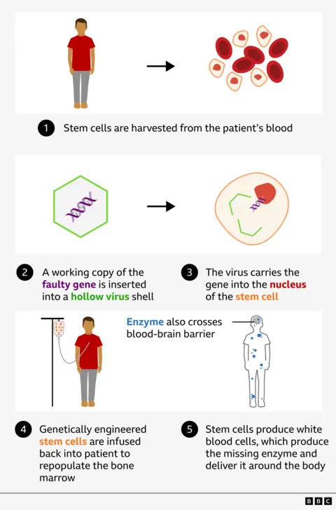 Graphic showing how genes are tweaked to treat Hunter syndrome
1. Stem cells are harvested from the patient's blood
2. A working copy of the faulty gene is inserted into a hollow virus shell
3. The virus carries the gene into the nucleus of the stem cell
4. Genetically engineered stem cells are infused back into patient to repopulate  the bone marrow
5. Stem cells produce white blood cells, which produce the missing enzyme and deliver it around the body